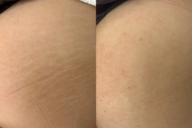 妊娠線 / 肉割れカモフラージュ